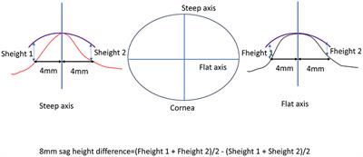 An integrative predictive model for orthokeratology lens decentration based on diverse metrics